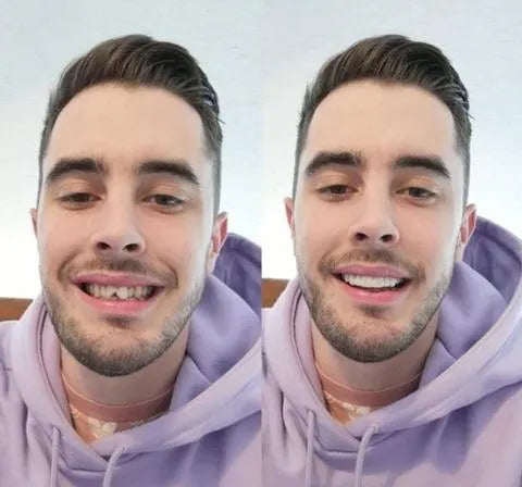 Over Smile Fineer Set voor Perfecte Glimlach 2